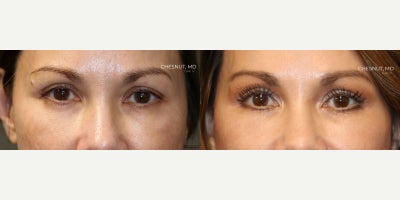 Eyelid Surgery before and after photo