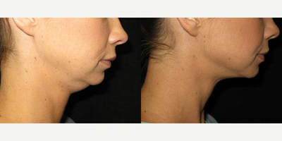 Laser Liposuction before and after photo