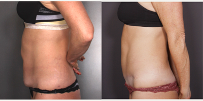 Liposuction before and after photo
