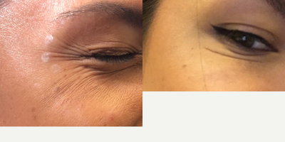 Botox before and after photo