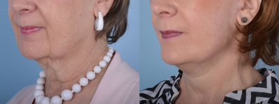 Facelift before and after photo
