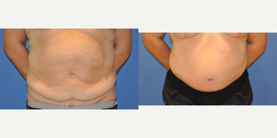 Tummy Tuck before and after photo