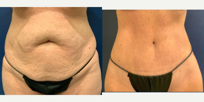 Tummy Tuck before and after photo