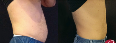 CoolSculpting before and after photo