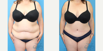 Tummy Tuck before and after photo