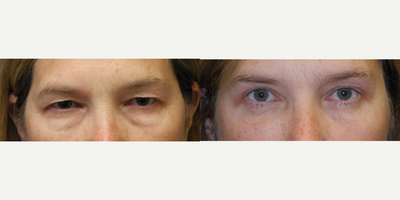 Brow Lift before and after photo