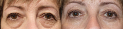 Eyelid Surgery before and after photo