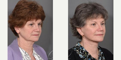 Facelift before and after photo