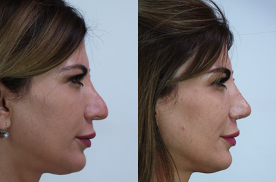 Revision Rhinoplasty before and after photo