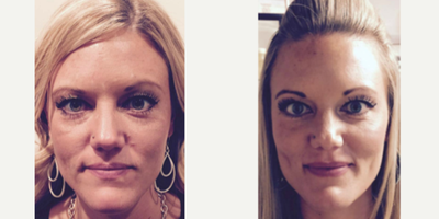Botox before and after photo