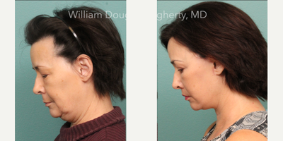 Brow Lift before and after photo