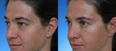 Eyelid Surgery before and after photo
