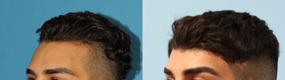 Forehead Reduction before and after photo