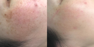 PicoSure before and after photo
