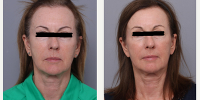 ActiveFX before and after photo