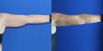 CoolSculpting before and after photo