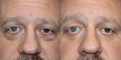 Eyelid Surgery before and after photo