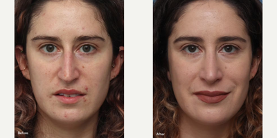 Rhinoplasty before and after photo