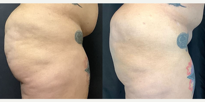 Brazilian Butt Lift before and after photo