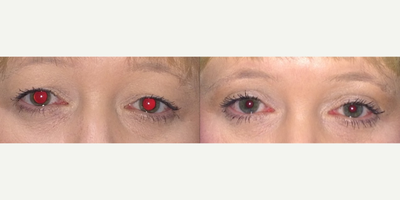 Eyelid Surgery before and after photo