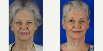 Eyelid Surgery before and after photo