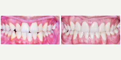 Invisalign before and after photo