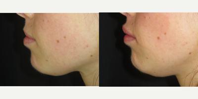 Lip Fillers before and after photo