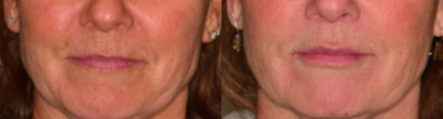 Restylane Silk before and after photo