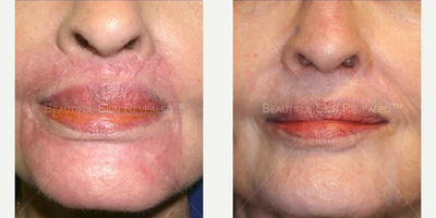 Vbeam before and after photo