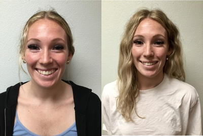 Botox for Gummy Smile before and after photo
