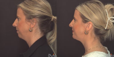 Chin Implant before and after photo