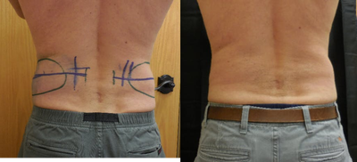 CoolSculpting before and after photo