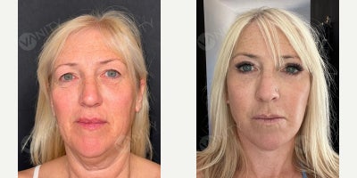 Eyelid Surgery before and after photo