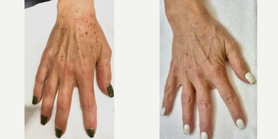 IPL before and after photo