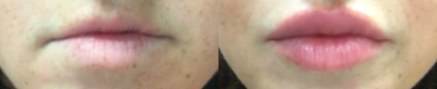Juvederm before and after photo
