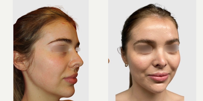 Rhinoplasty before and after photo