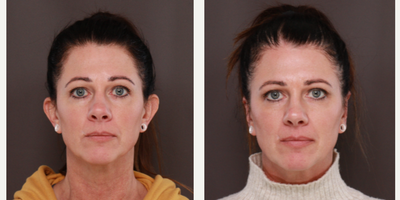 Ear Surgery before and after photo