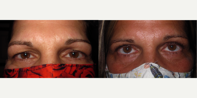 Eyelid Surgery before and after photo