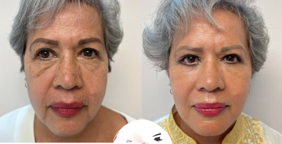 Eyelid Surgery before and after photo