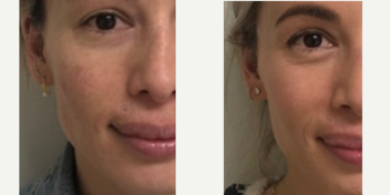 Fraxel Laser before and after photo