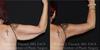 Arm Lift before and after photo