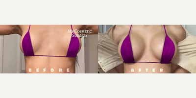 Breast Implants before and after photo