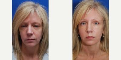 Brow Lift before and after photo