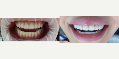 Porcelain Veneers before and after photo