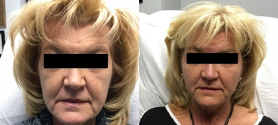 Bellafill before and after photo