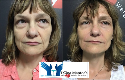 Eyelid Surgery before and after photo