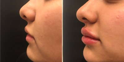 Juvederm before and after photo