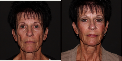 Nonsurgical Facelift before and after photo