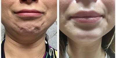 Botox before and after photo