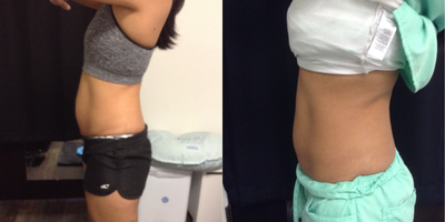 CoolSculpting before and after photo